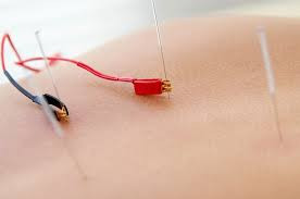Electro-Acupuncture: The Powerhouse Therapy for Chronic Joint Pain and Orthopedic Conditions