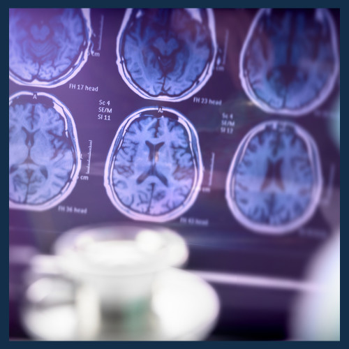 The Science Behind Dementia: How the Brain Changes Over Time