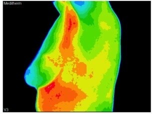 Thermography vs Mammography